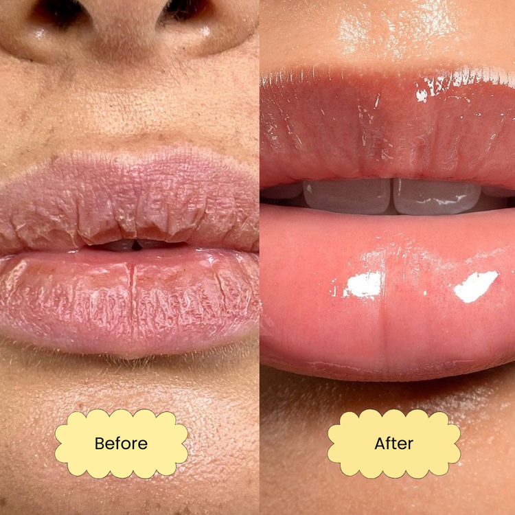 Before and after comparison of lips with a lip balm application. The picture labelled "before", the woman had dry lips and the picture labelled "after" had hydrated glossy lips